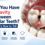 Do You Have a Cavity Between Molar Teeth
